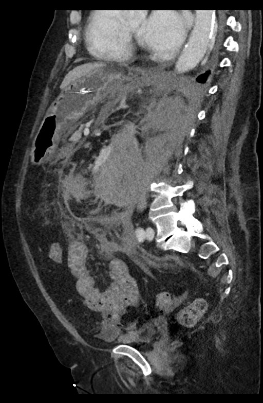 Active renal extravasation with large subcapsular and retroperitoneal hemorrhage (Radiopaedia 60975-68796 Sagittal C+ portal venous phase 104).jpg