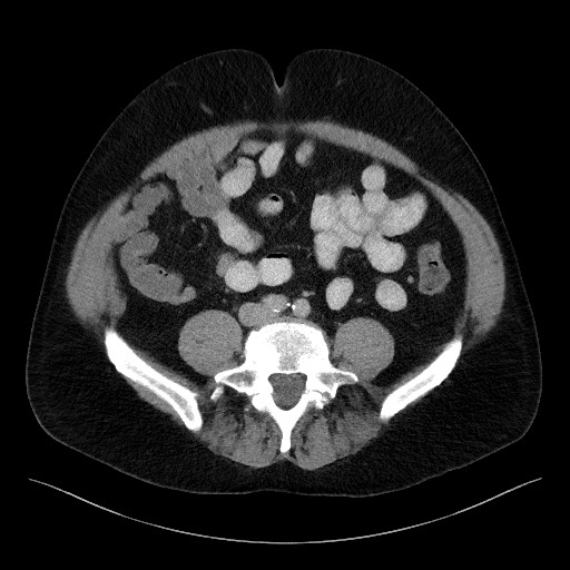 Acute-on-chronic pancreatitis (Radiopaedia 67286-76656 Axial C+ portal venous phase 52).jpg