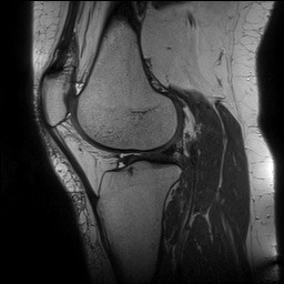 Acute-on-chronic transient lateral patellar dislocation with trochlear dysplasia (Radiopaedia 84099-99349 Sagittal PD 103).jpg