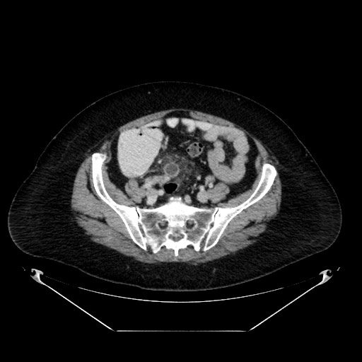 File:Acute appendicitis, heterotaxy syndrome (Radiopaedia 66884-76202 Axial 40).jpg
