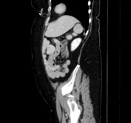 Acute appendicitis, heterotaxy syndrome (Radiopaedia 66884-76202 Sagittal C+ portal venous phase 103).jpg
