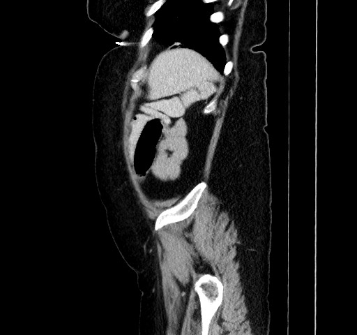 Acute appendicitis, heterotaxy syndrome (Radiopaedia 66884-76202 Sagittal C+ portal venous phase 111).jpg