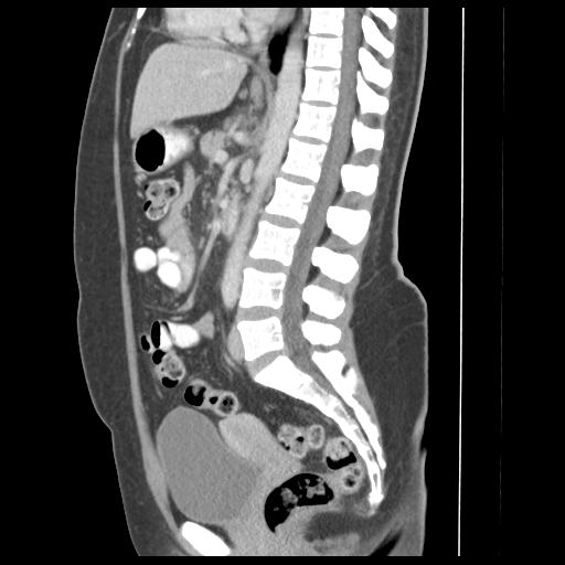 Acute appendicitis (Radiopaedia 30297-30934 Coronal C+ portal venous phase 1).jpg