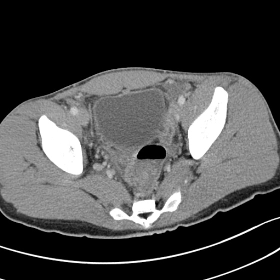 File:Acute appendicitis (Radiopaedia 32614-33572 Axial C+ portal venous phase 58).jpg