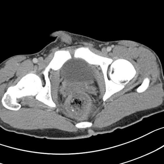 File:Acute appendicitis (Radiopaedia 32614-33572 Axial C+ portal venous phase 66).jpg
