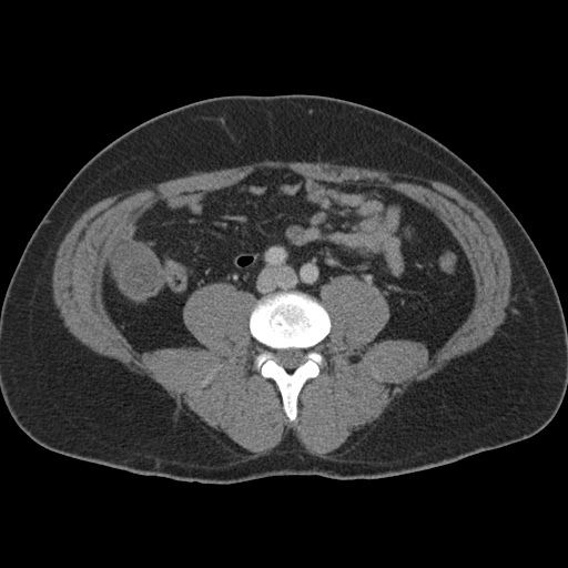 Acute appendicitis (Radiopaedia 48511-53463 Axial C+ portal venous phase 64).jpg