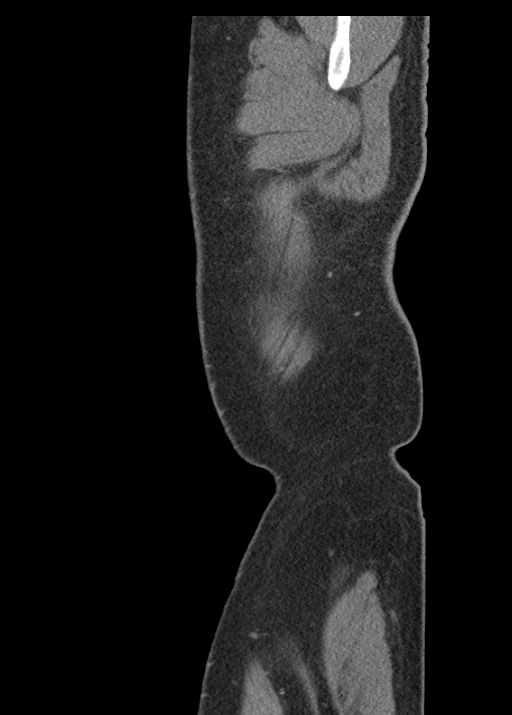 Acute appendicitis (Radiopaedia 48511-53463 Sagittal C+ portal venous phase 14).jpg
