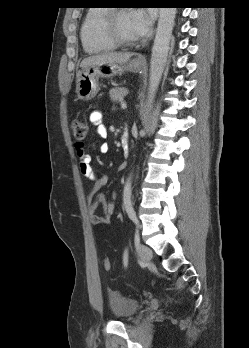 Acute appendicitis (Radiopaedia 48511-53463 Sagittal C+ portal venous phase 79).jpg
