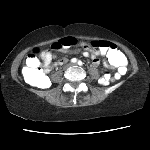 File:Acute appendicitis (Radiopaedia 52672-58589 Axial C+ arterial phase 7).jpg