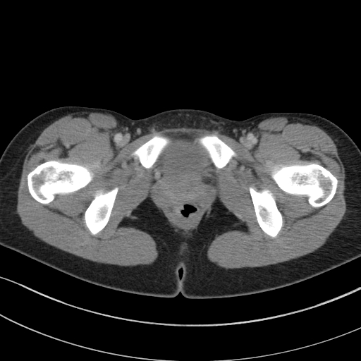 File:Acute appendicitis (Radiopaedia 62608-70901 Axial C+ portal venous phase 63).jpg
