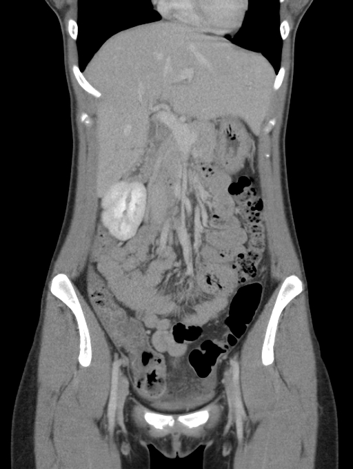 Acute appendicitis (Radiopaedia 62608-70901 Coronal C+ portal venous phase 14).jpg