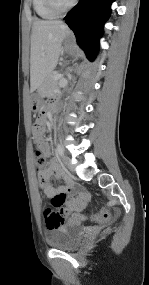 Acute appendicitis (Radiopaedia 62608-70901 Sagittal C+ portal venous phase 10).jpg