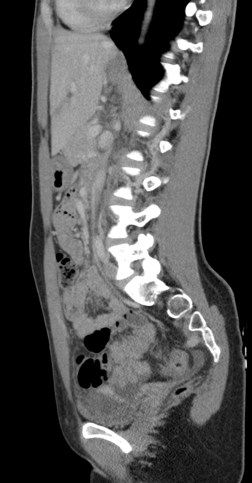 Acute appendicitis (Radiopaedia 62608-70901 Sagittal C+ portal venous phase 11).jpg