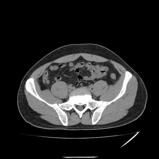 File:Acute appendicitis (Radiopaedia 81320-95015 A 12).jpg