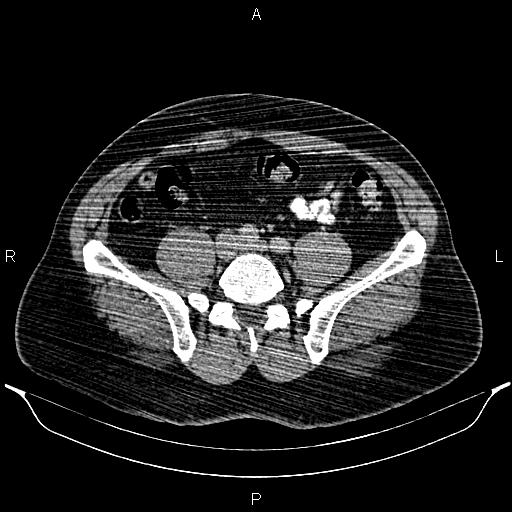 Acute appendicitis (Radiopaedia 84780-100240 Axial C+ portal venous phase 75).jpg