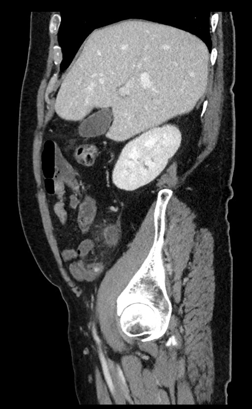 Acute appendicitis - large appendicoliths (Radiopaedia 61805-69820 Sagittal C+ portal venous phase 85).jpg