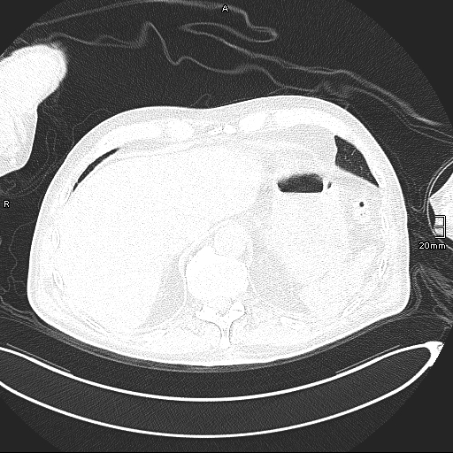 Acute aspiration pneumonitis (Radiopaedia 55642-62166 Axial lung window 138).jpg