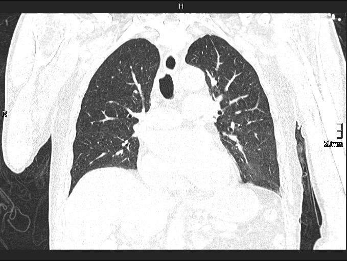 Acute aspiration pneumonitis (Radiopaedia 55642-62166 Coronal lung window 49).jpg