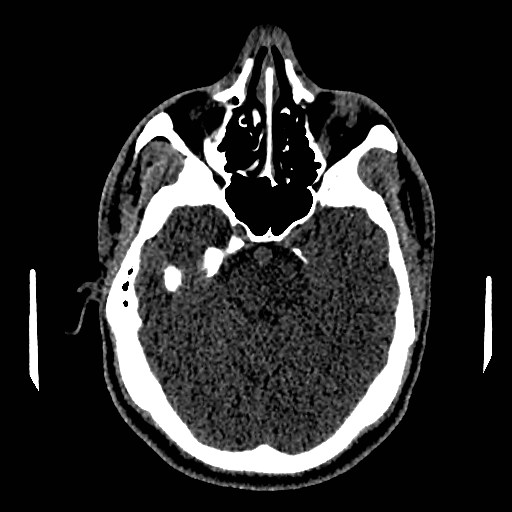 Acute basilar artery occlusion (Radiopaedia 43582-46985 Axial non-contrast 67).jpg