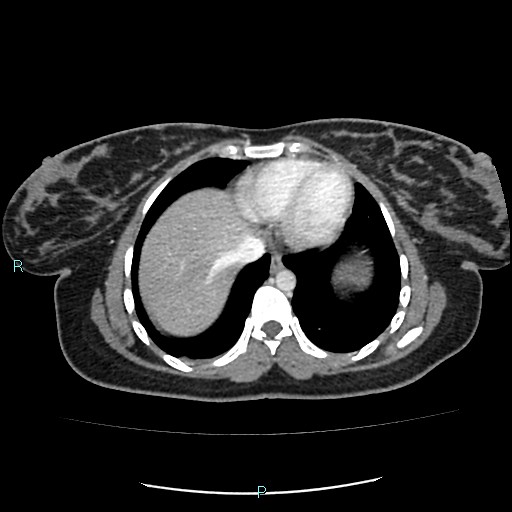 Acute bilateral pyelonephritis (Radiopaedia 37146-38881 Axial C+ portal venous phase 4).jpg