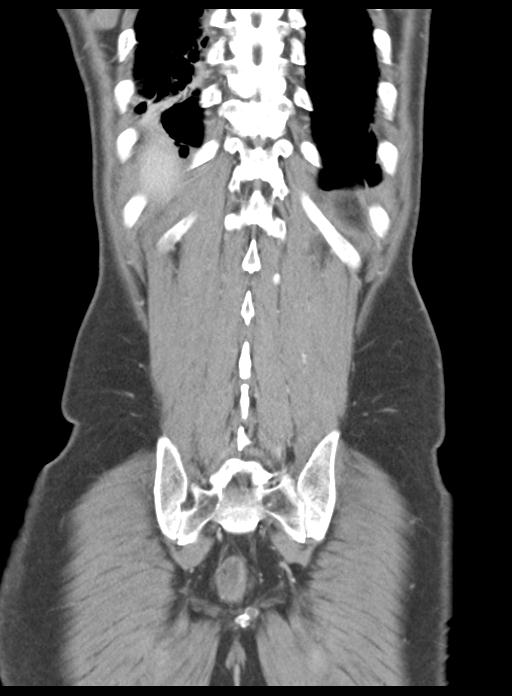 Acute cholecystitis (Radiopaedia 29814-30327 Coronal C+ portal venous phase 44).jpg