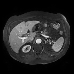 Acute cholecystitis complicated by pylephlebitis (Radiopaedia 65782-74915 Axial arterioportal phase T1 C+ fat sat 49).jpg