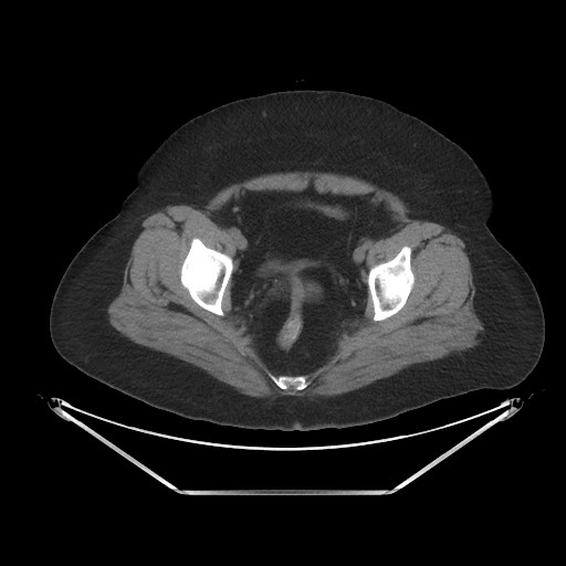 File:Acute cholecystitis with tensile fundus sign (Radiopaedia 71394-81723 Axial non-contrast 105).jpg