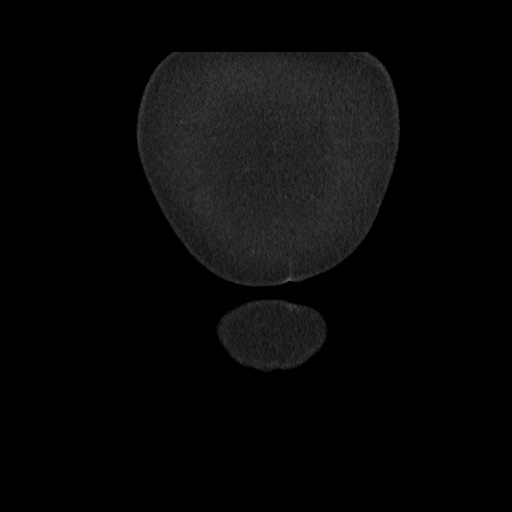 Acute cholecystitis with tensile fundus sign (Radiopaedia 71394-81723 Coronal non-contrast 13).jpg