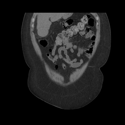 Acute cholecystitis with tensile fundus sign (Radiopaedia 71394-81723 Coronal non-contrast 36).jpg