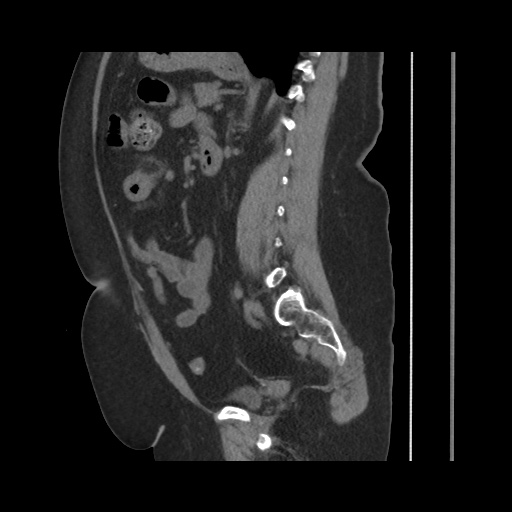 Acute cholecystitis with tensile fundus sign (Radiopaedia 71394-81723 Sagittal non-contrast 101).jpg
