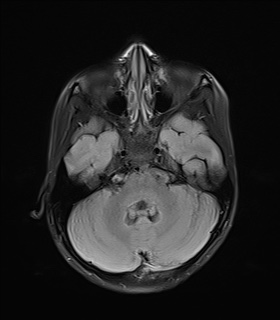 File:Acute disseminating encephalomyelitis with bilateral optic neuritis (Radiopaedia 79676-92886 Axial FLAIR 7).jpg