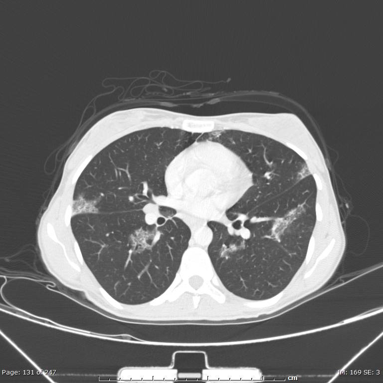 Acute eosinophilic pneumonia (Radiopaedia 48211-53073 Axial lung window 47).jpg