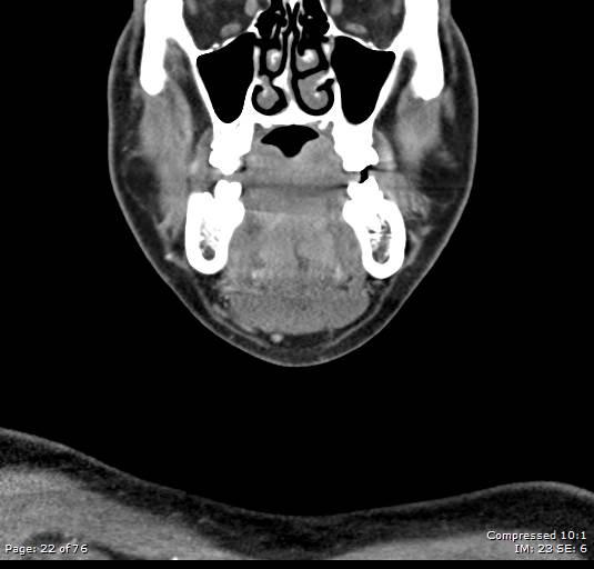 Acute epiglottitis (Radiopaedia 54375-60590 Coronal C+ arterial phase 22).jpg