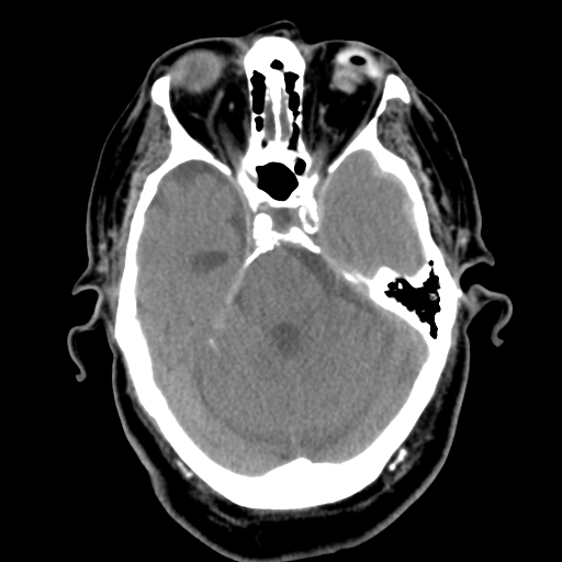 Acute hemorrhagic stroke (Radiopaedia 17507-17223 Axial non-contrast 17).jpg