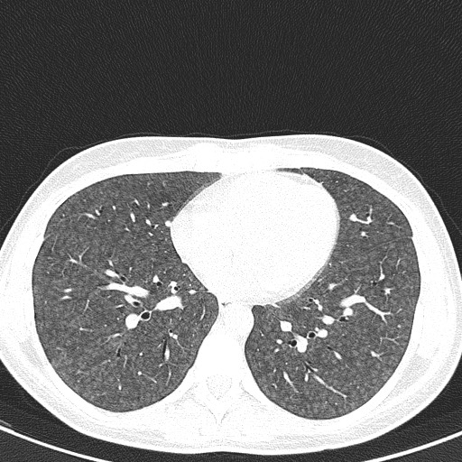 File:Acute hypersensitivity pneumonitis (Radiopaedia 85293-100870 Axial lung window 76).jpg