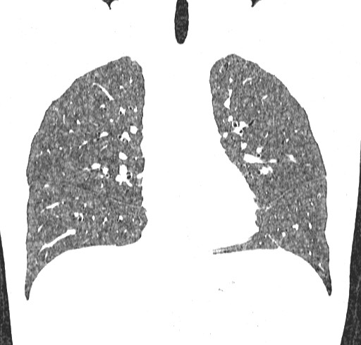 File:Acute hypersensitivity pneumonitis (Radiopaedia 85293-100870 Coronal lung window 53).jpg