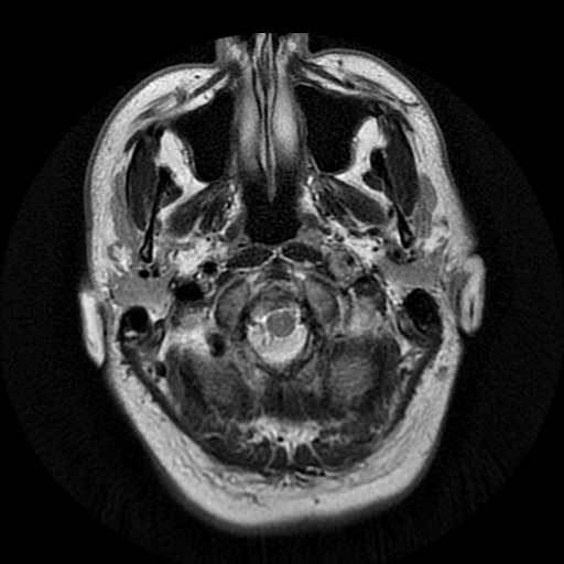 File:Acute internal carotid artery dissection (Radiopaedia 53541-59632 Axial T2 2).jpg