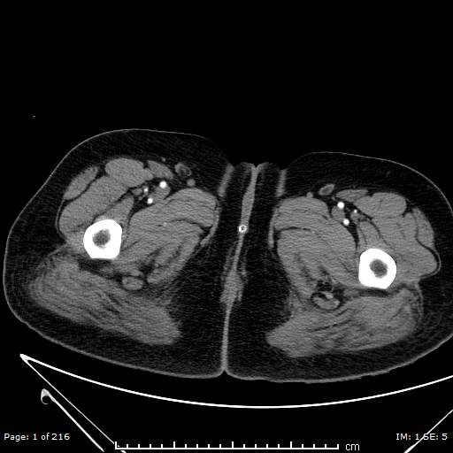 File:Acute interstitial pancreatitis with acute peripancreatic fluid collections (Radiopaedia 71356).jpg