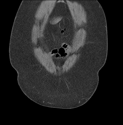 Acute mesenteric venous ischemia (Radiopaedia 46041-50383 Coronal C+ portal venous phase 11).jpg