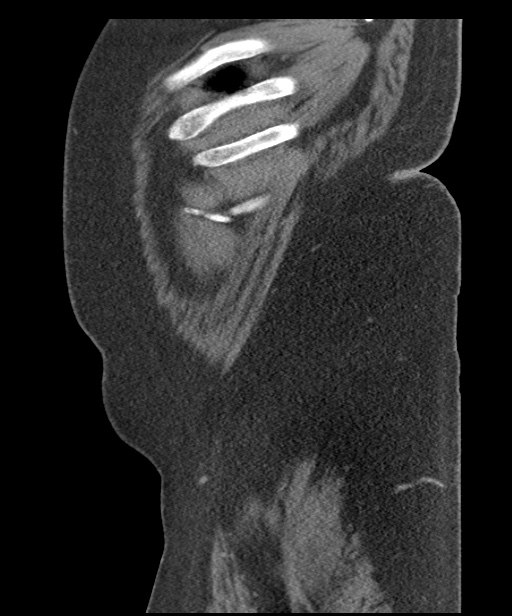Acute mesenteric venous ischemia (Radiopaedia 46041-50383 Sagittal C+ portal venous phase 113).jpg