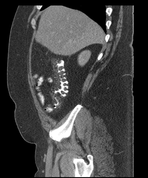 Acute mesenteric venous ischemia (Radiopaedia 46041-50383 Sagittal C+ portal venous phase 23).jpg