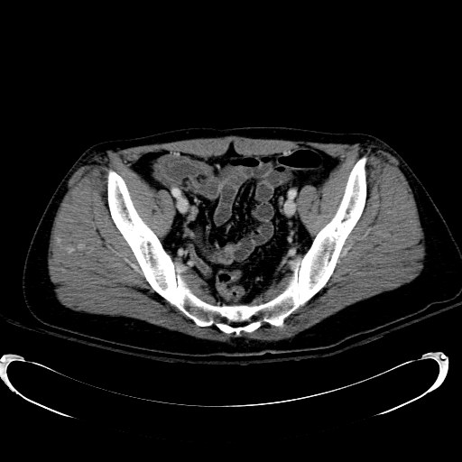 Acute myocardial infarction in CT (Radiopaedia 39947-42415 Axial C+ portal venous phase 108).jpg