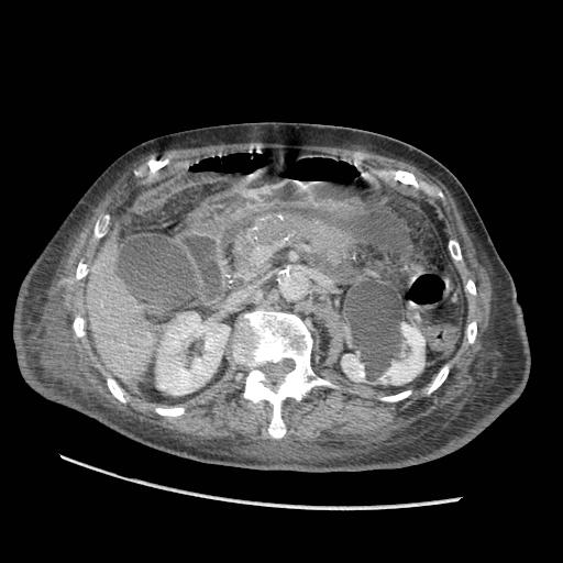 Acute on chronic pancreatitis (Radiopaedia 13233-13244 Axial C+ portal venous phase 39).jpg