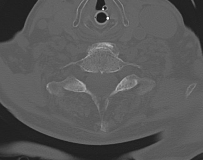 Acute on chronic subdural hematoma and thoracic vertebral injury in a multitrauma patient (Radiopaedia 31698-32619 Axial bone window 46).jpg