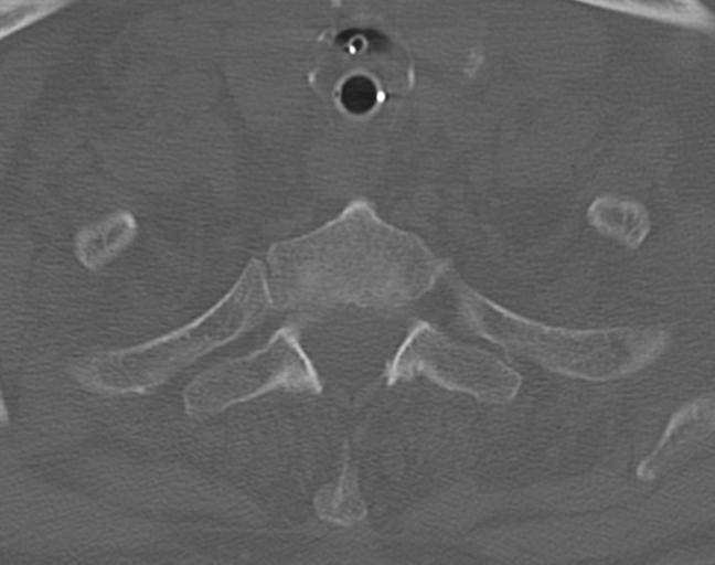 Acute on chronic subdural hematoma and thoracic vertebral injury in a multitrauma patient (Radiopaedia 31698-32619 Axial bone window 55).jpg
