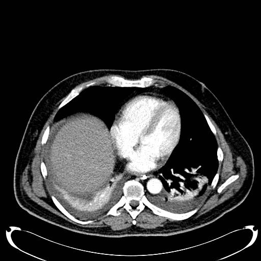 Acute pancreatic necrosis (Radiopaedia 13560-18500 Axial C+ portal venous phase 12).jpg