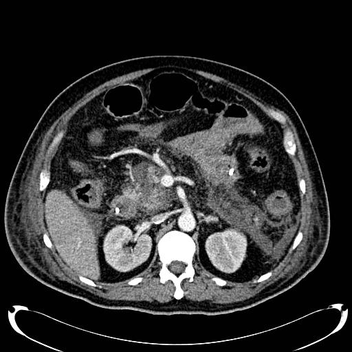 Acute pancreatic necrosis (Radiopaedia 13560-18500 Axial C+ portal venous phase 59).jpg
