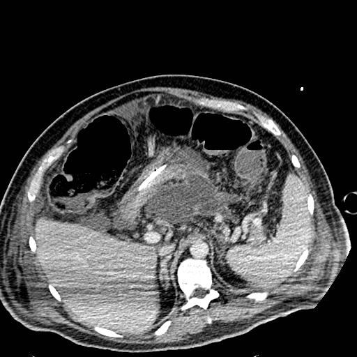 Acute pancreatic necrosis (Radiopaedia 13560-18501 Axial C+ portal venous phase 36).jpg