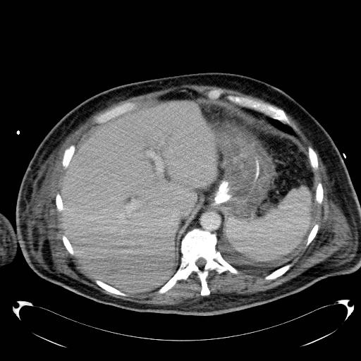 Acute pancreatic necrosis (Radiopaedia 13560-18503 Axial C+ portal venous phase 14).jpg