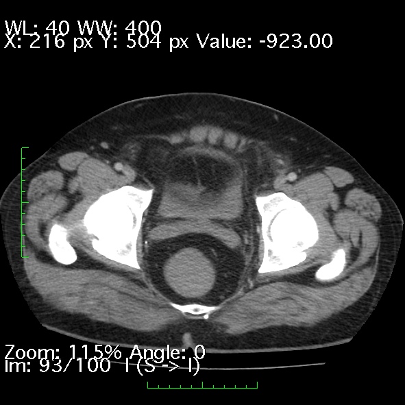 File:Acute pancreatitis (Radiopaedia 34043-35276 Axial C+ portal venous phase 93).jpg